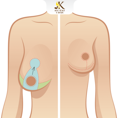 Chi phí nâng ngực chảy xệ