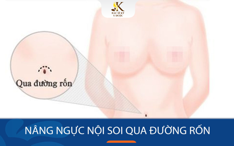 Nâng ngực nội soi qua đường rốn