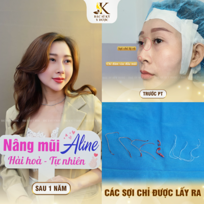 Giải cứu Nâng Mũi Chỉ Hiko